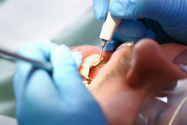Best Emergency Treatment for Dental Infections or Abscesses in Cedar Mill, OR