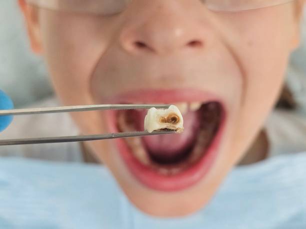 Best Urgent Care for Lost Fillings or Crowns in Cedar Mill, OR